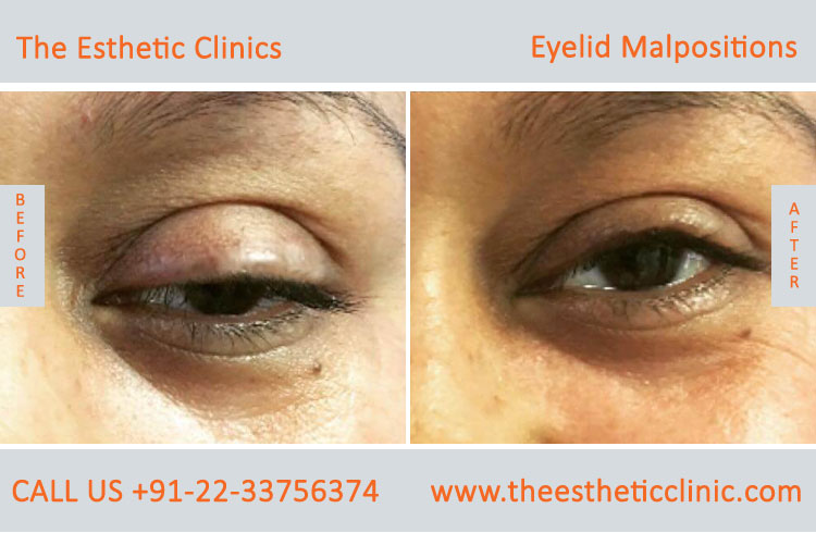 Eyelid Malpostions, Ectropion Entropion Surgery before after photos in mumbai india (5)